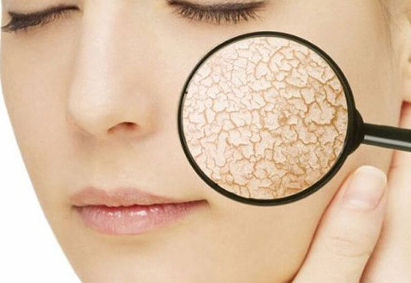 Yazın Cilt Neden Kurur?